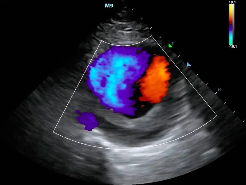 Color Doppler at Horizon Hospital